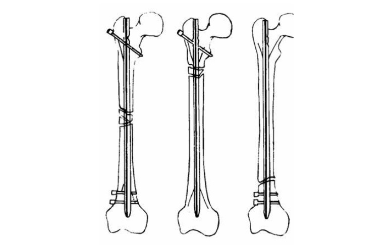 骨科金屬植入物產(chǎn)品注冊(cè)申報(bào)資料關(guān)注點(diǎn)(圖1)
