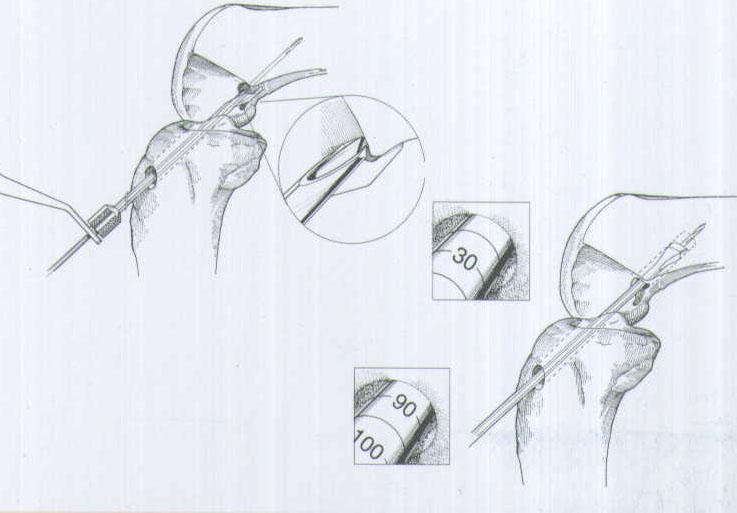 肌腱韌帶固定系統(tǒng)注冊技術審查指導原則（2020年第36號）